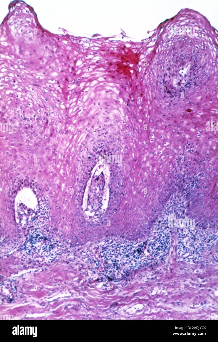 Genital Wart Light Micrograph Of Section Through A Genital Wart Condyloma From The Human 