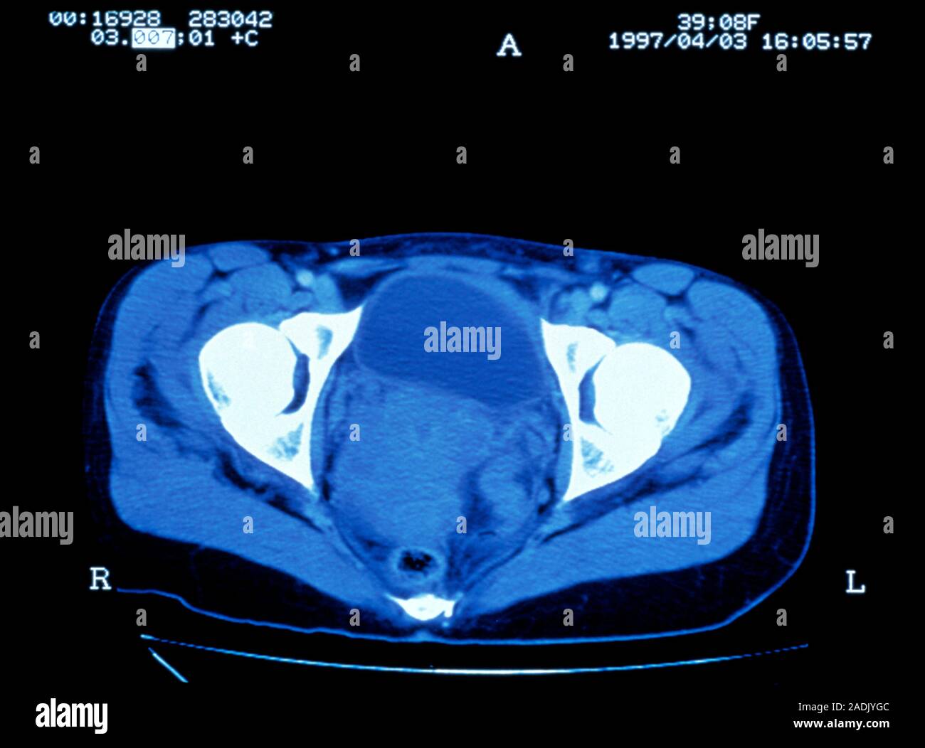 Cervical cancer. Coloured computed tomography (CT) scan of an axial ...