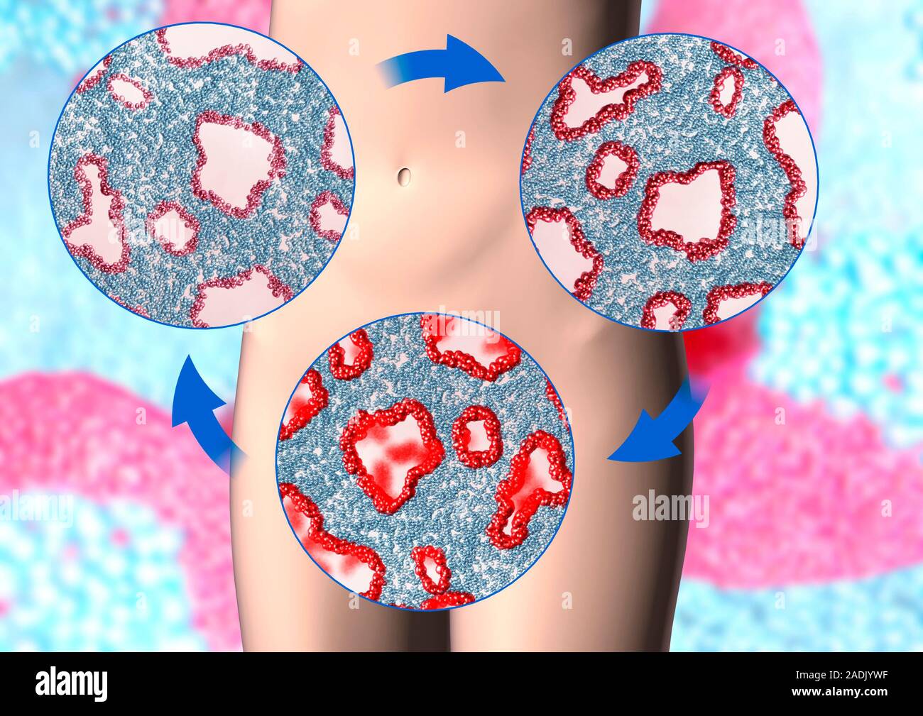 Endometriosis. Computer artwork of endrometriomas, masses of cells from ...