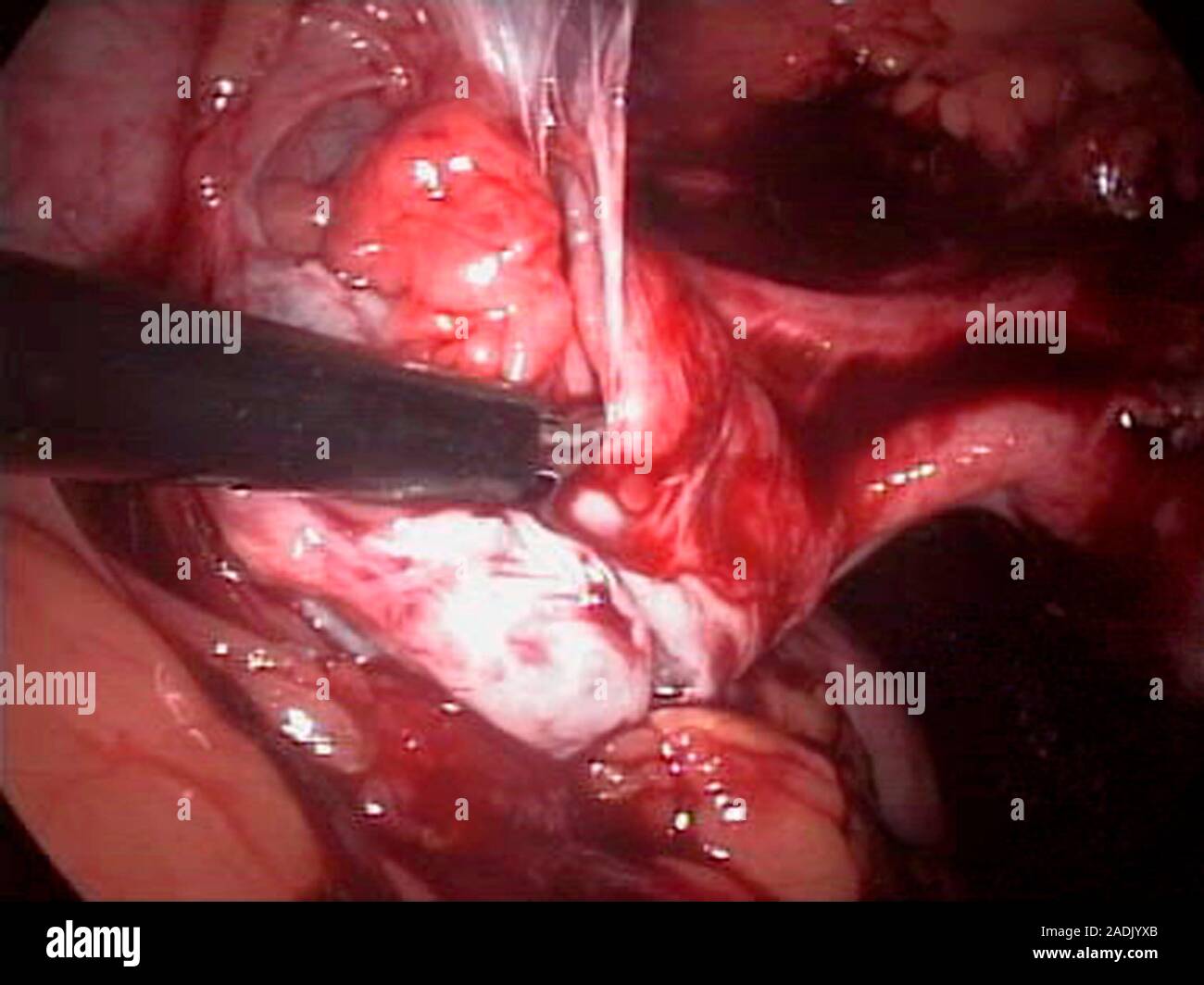 Fallopian tube surgery, endoscope view. Surgical instrument cutting ...