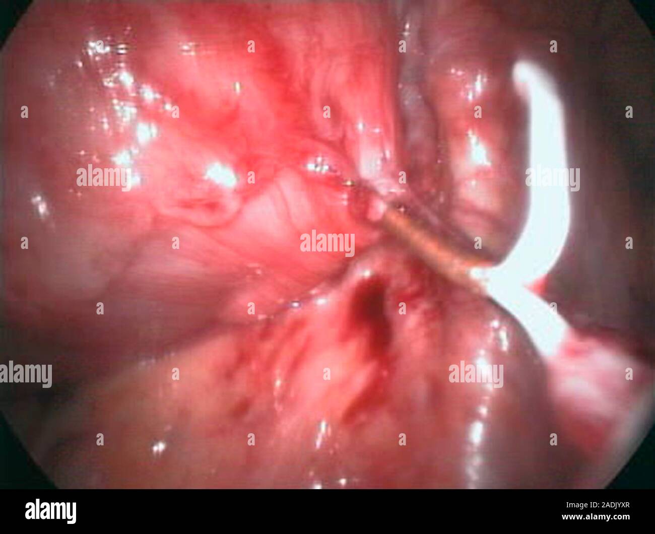 Removal of a displaced IUD contraceptive. Endoscope view of an