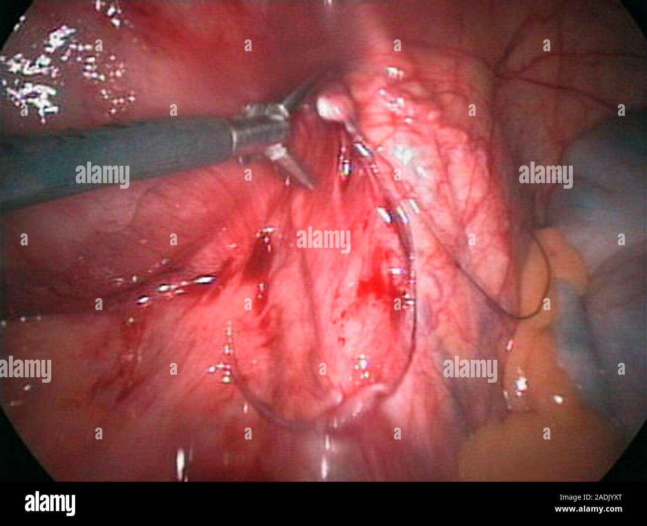 Removal of a displaced IUD contraceptive. Endoscope view of a surgical