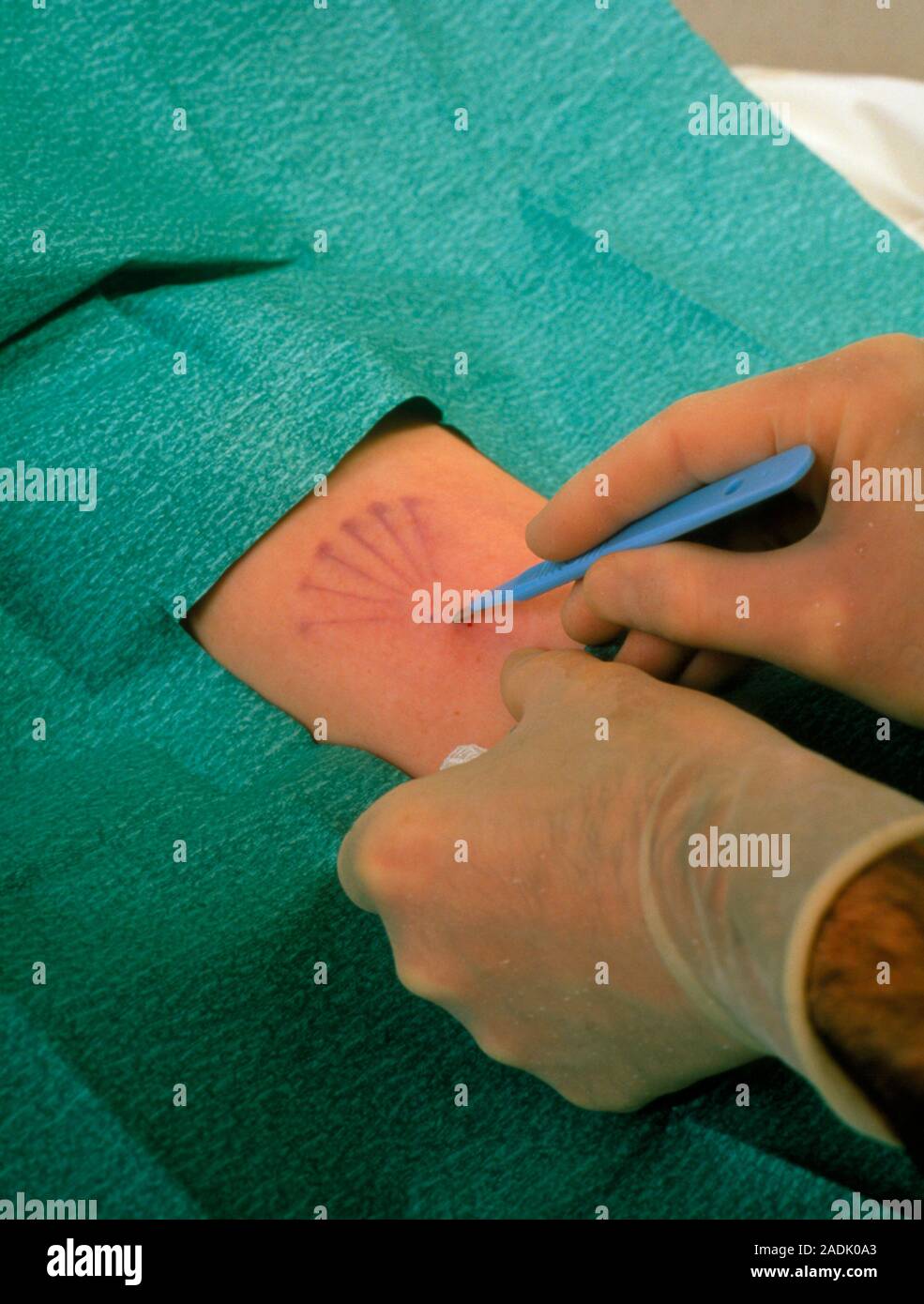 Contraceptive implant surgery. A scalpel is used to cut a small ...