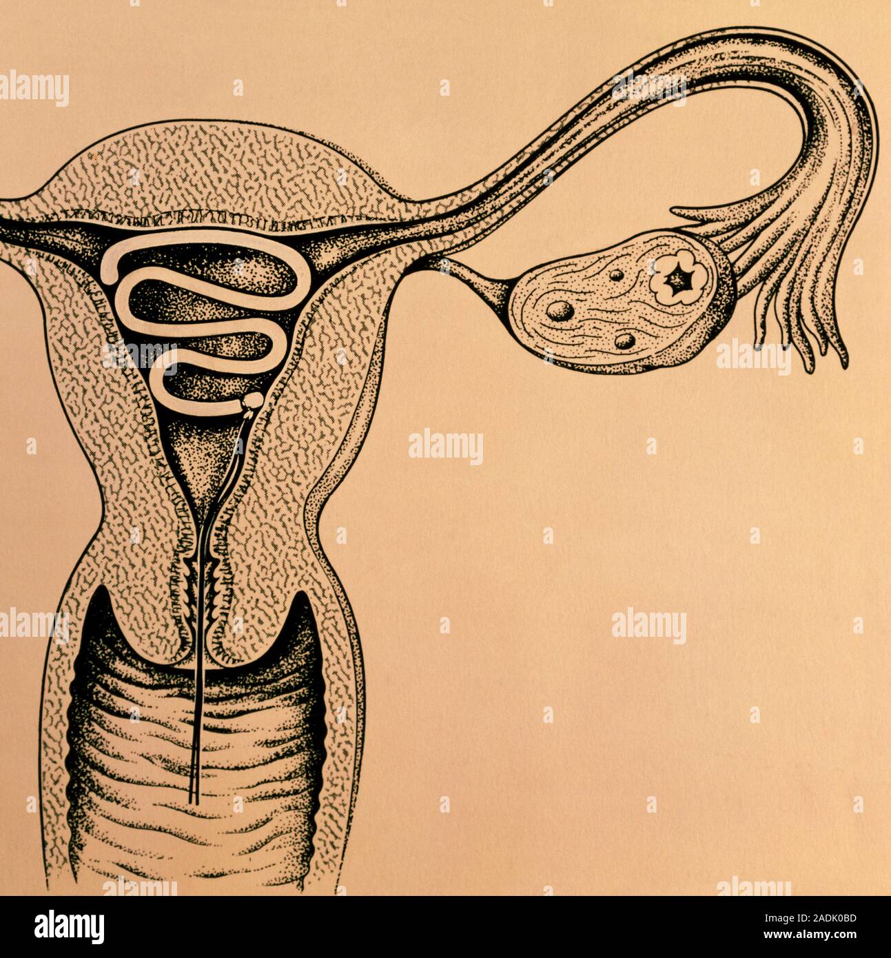 Intrauterine device. Artwork of an intrauterine contraceptive device