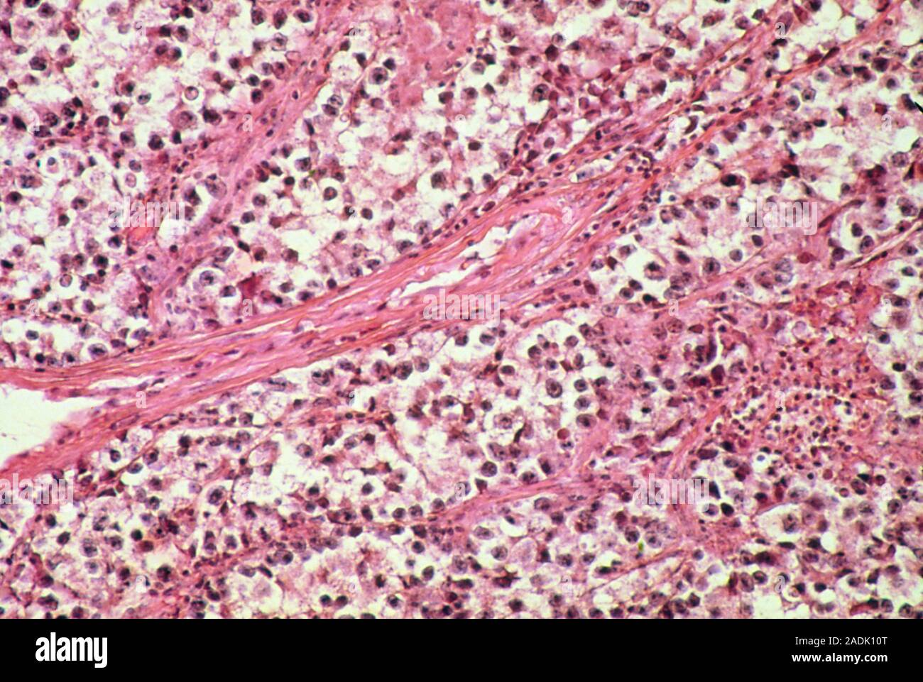 Testicular cancer. Light micrograph of a section through a tumour in a