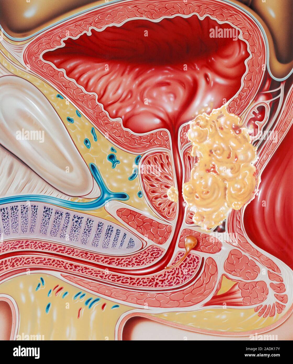 Онкологии предстательной железы у мужчин. Предстательная железа, Prostata. Карцинома предстательной железы. Мочевой пузырь. Простата у мужчин.