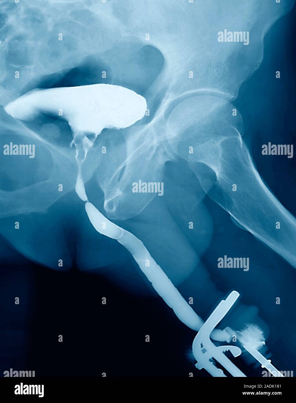 Prostate cancer. Urogram (X-ray) of the pelvis of a 60 year old man ...