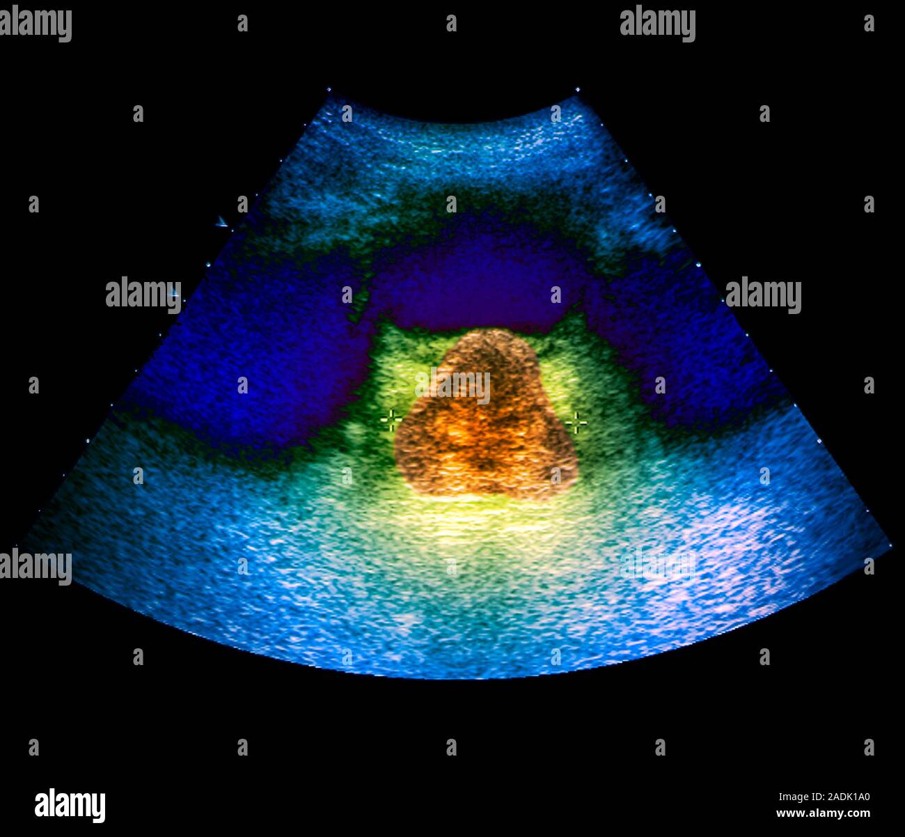 Prostate Tumour Coloured Ultrasound Scan Of A Section Through The