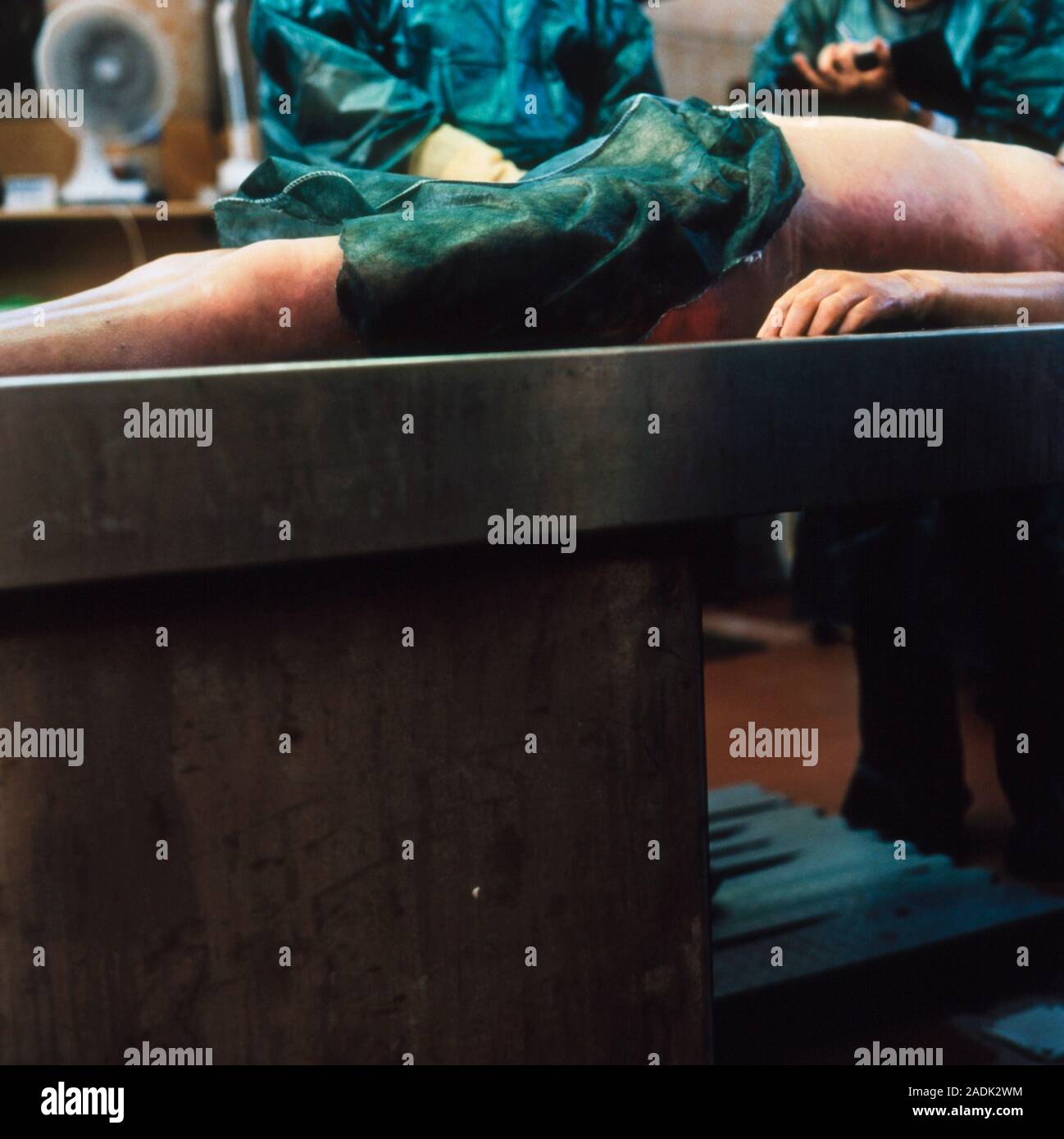 Autopsy examination. Mortuary technicians with the corpse of a 20 year