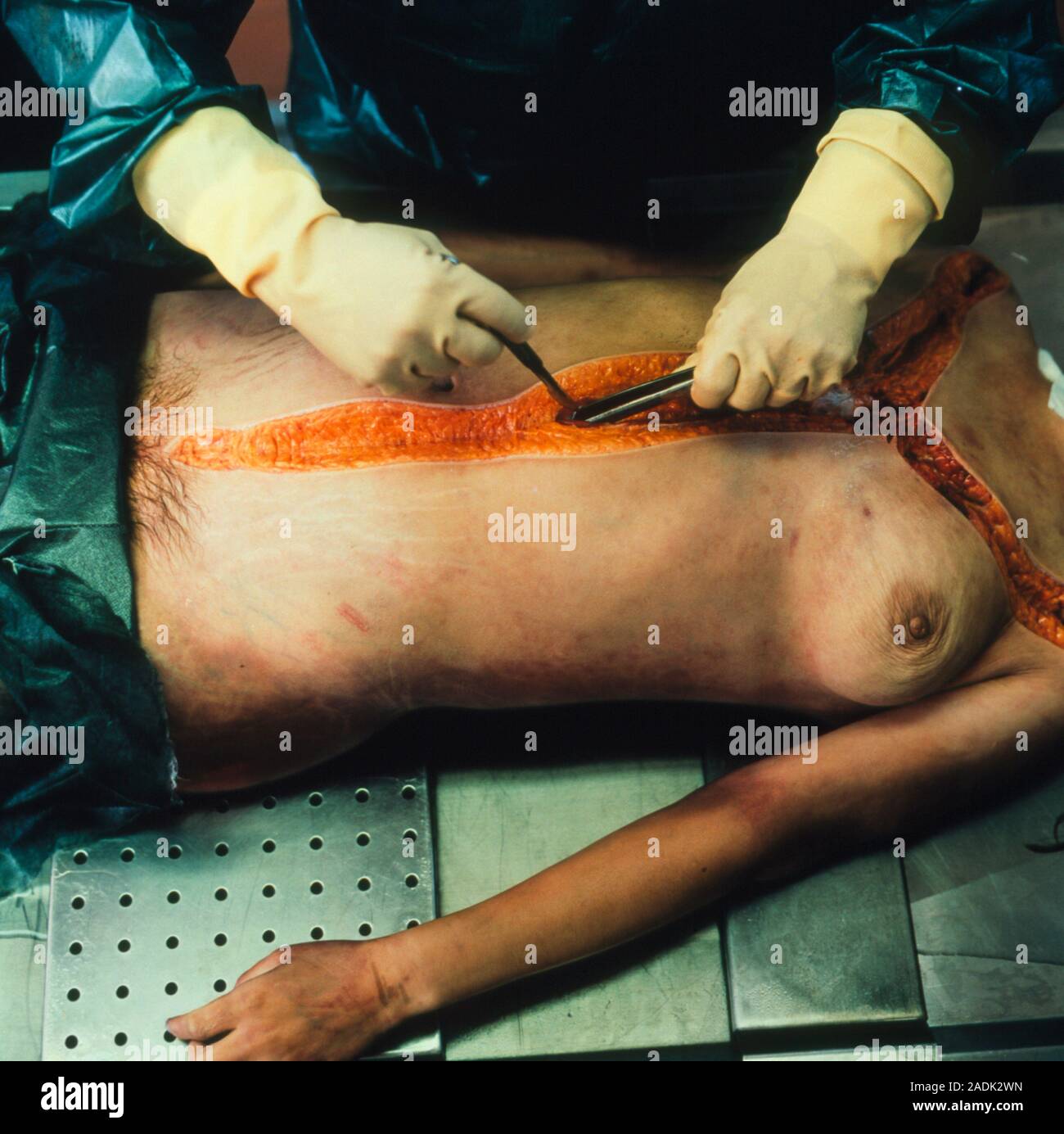 autopsy girls  