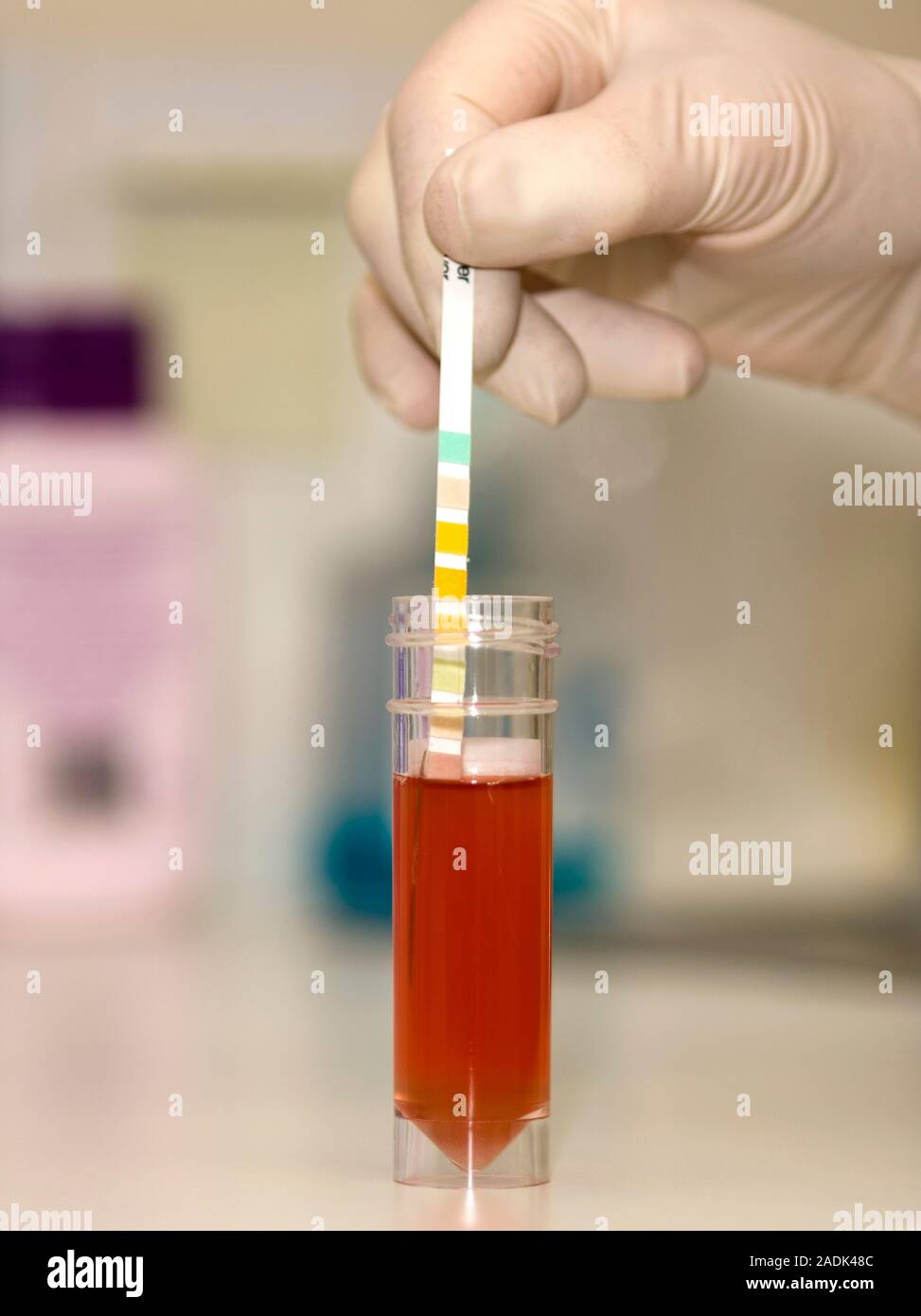 Testing for blood in urine (haematuria), using a test stick. The cause