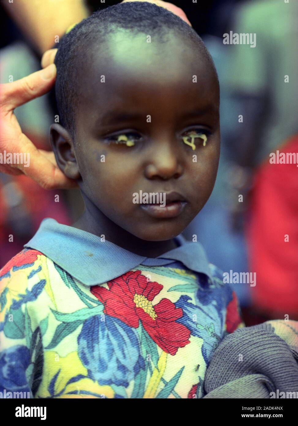 Trachoma eye infection Âtreatment. Â ÂYoung Âchild being Âtreated Âwith