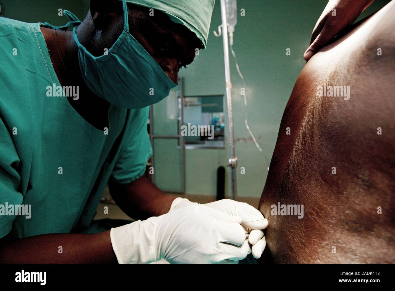MODEL RELEASED. Epidural anaesthetic. Anaesthetist inserting a guide