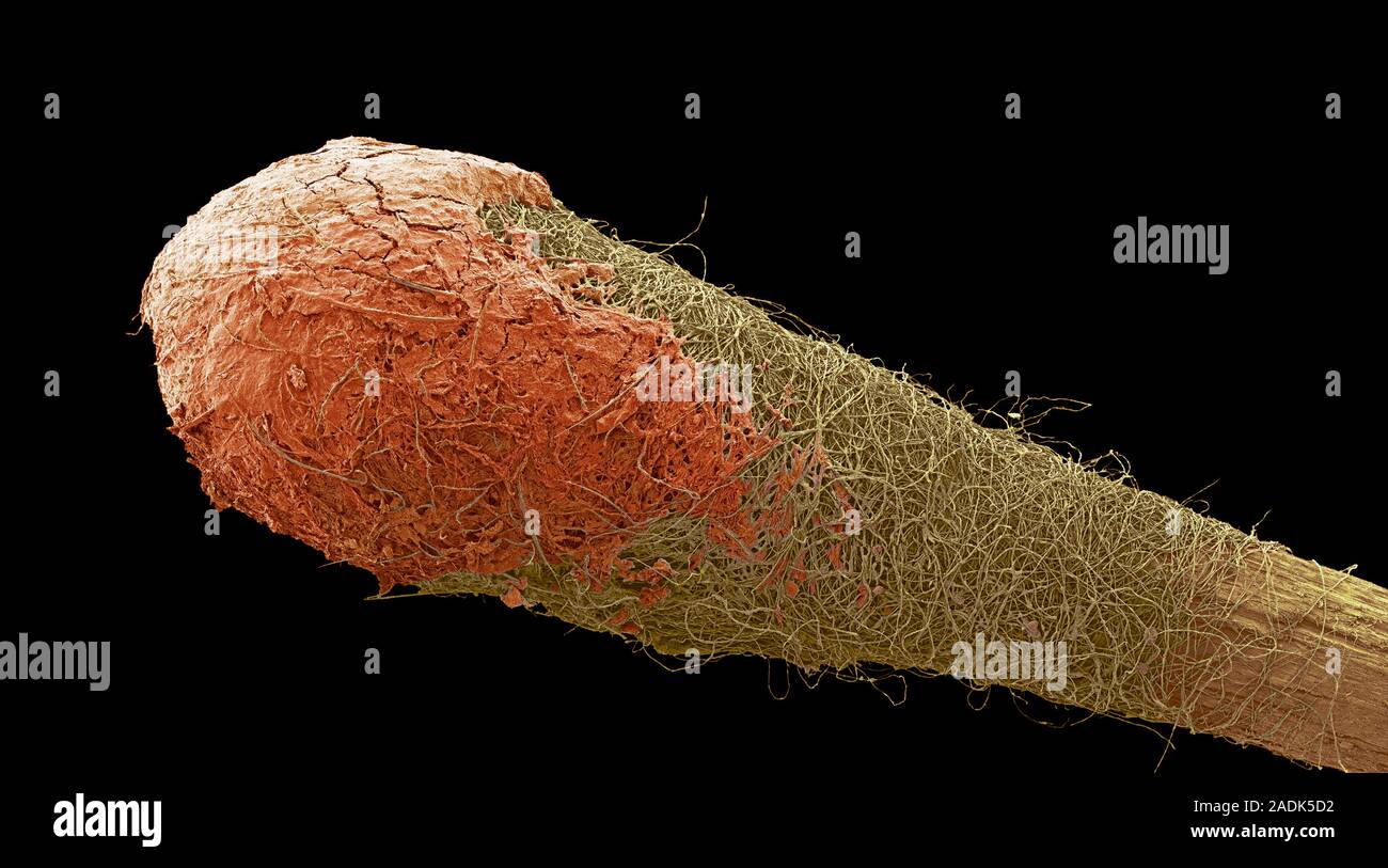 Cotton bud with ear wax (red), coloured scanning electron micrograph