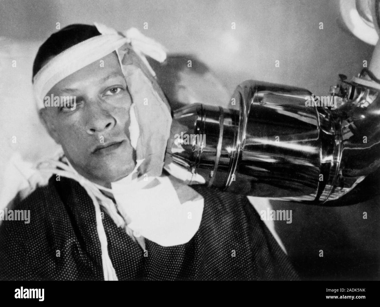 Radium therapy. Man with neck cancer receiving radiotherapy treatment