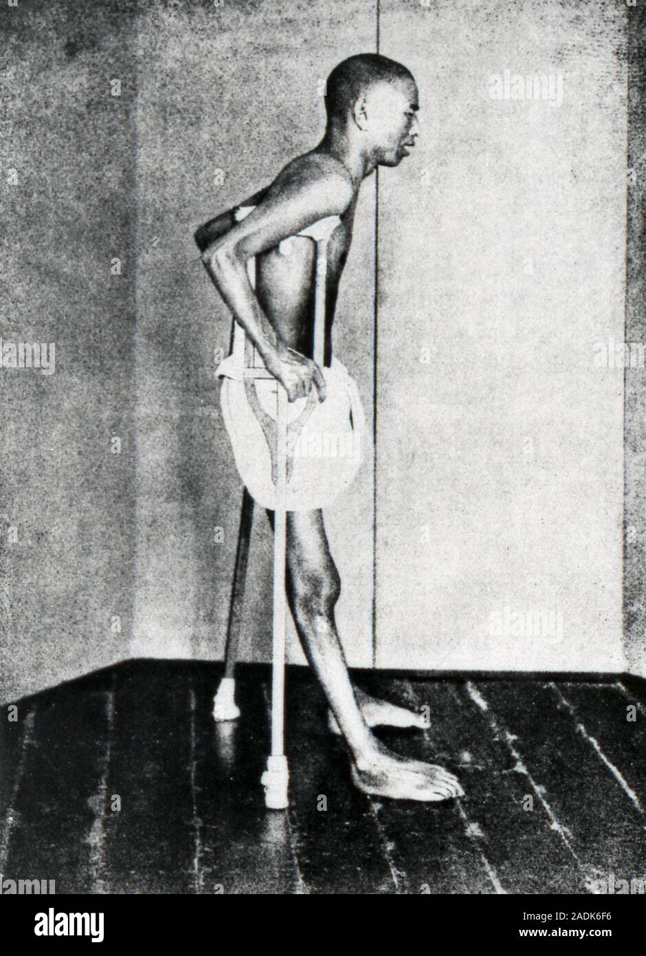 Beriberi patient on crutches. Beriberi is a disorder of the nervous