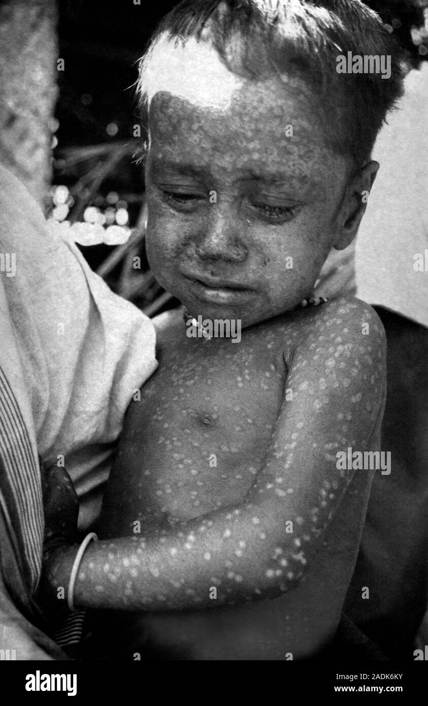 Last smallpox major infection. Image 1 of 2. This case, one of the last ...