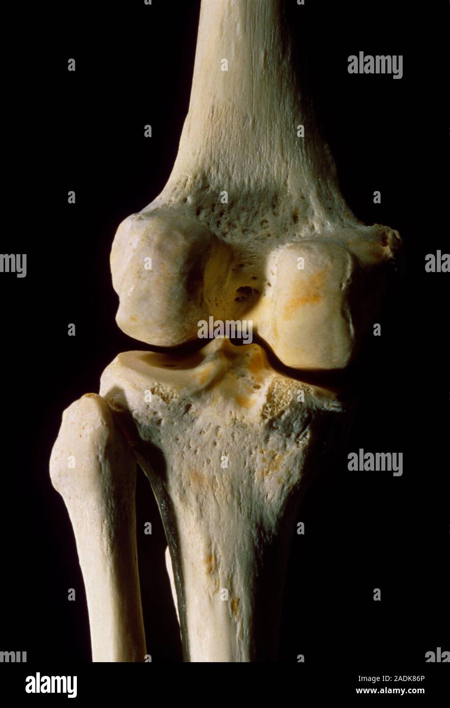 Photograph of the bones articulating the human left knee (genual) joint, seen in posterior