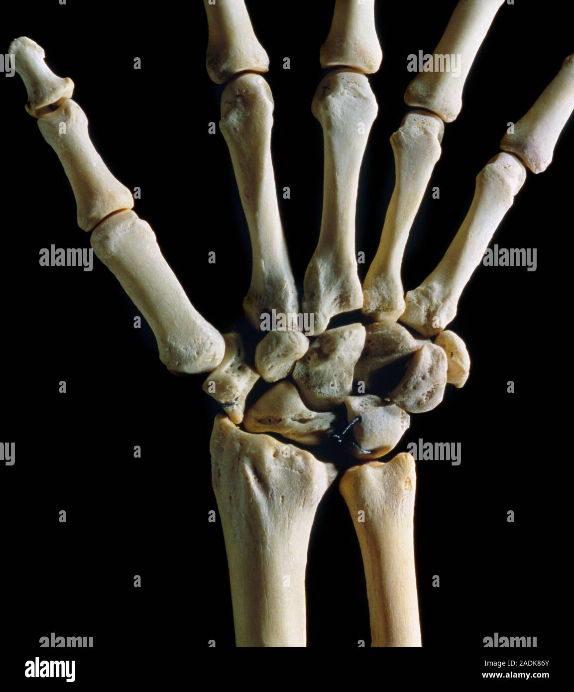 Photograph of the skeleton of the left wrist joint, showing (from bottom)  the forearm bones (radius at left, ulna at right), the carpal (wrist) bones  Stock Photo - Alamy, image size:1153x1390