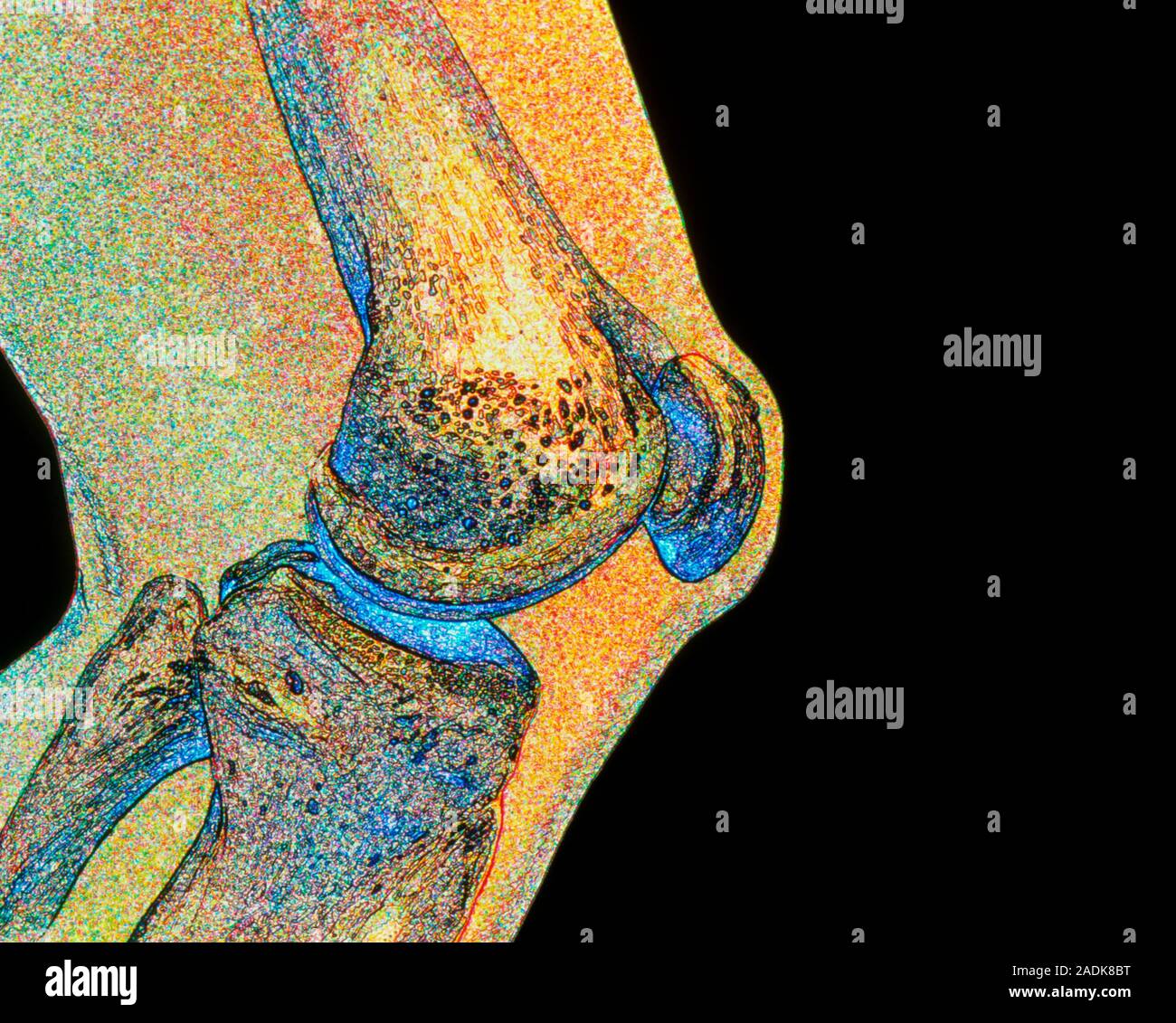 Knee joint. Artwork of a side view of the human knee joint. Two bones ...