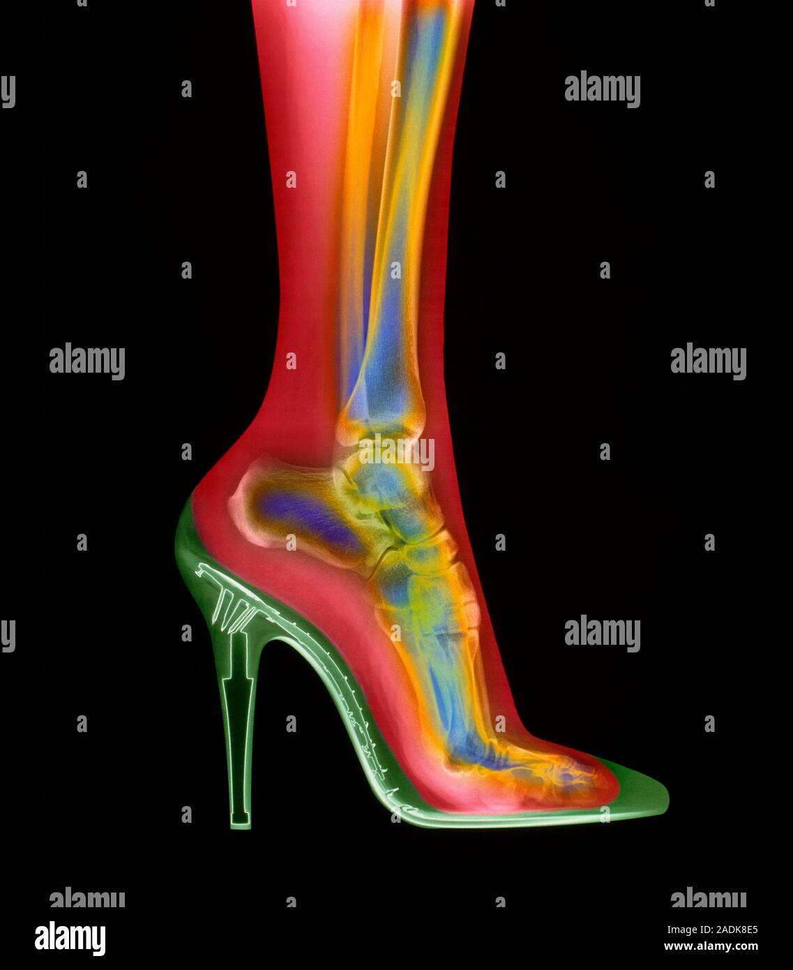 Foot in shoe. Coloured X-ray of a woman's foot seen in side view ...
