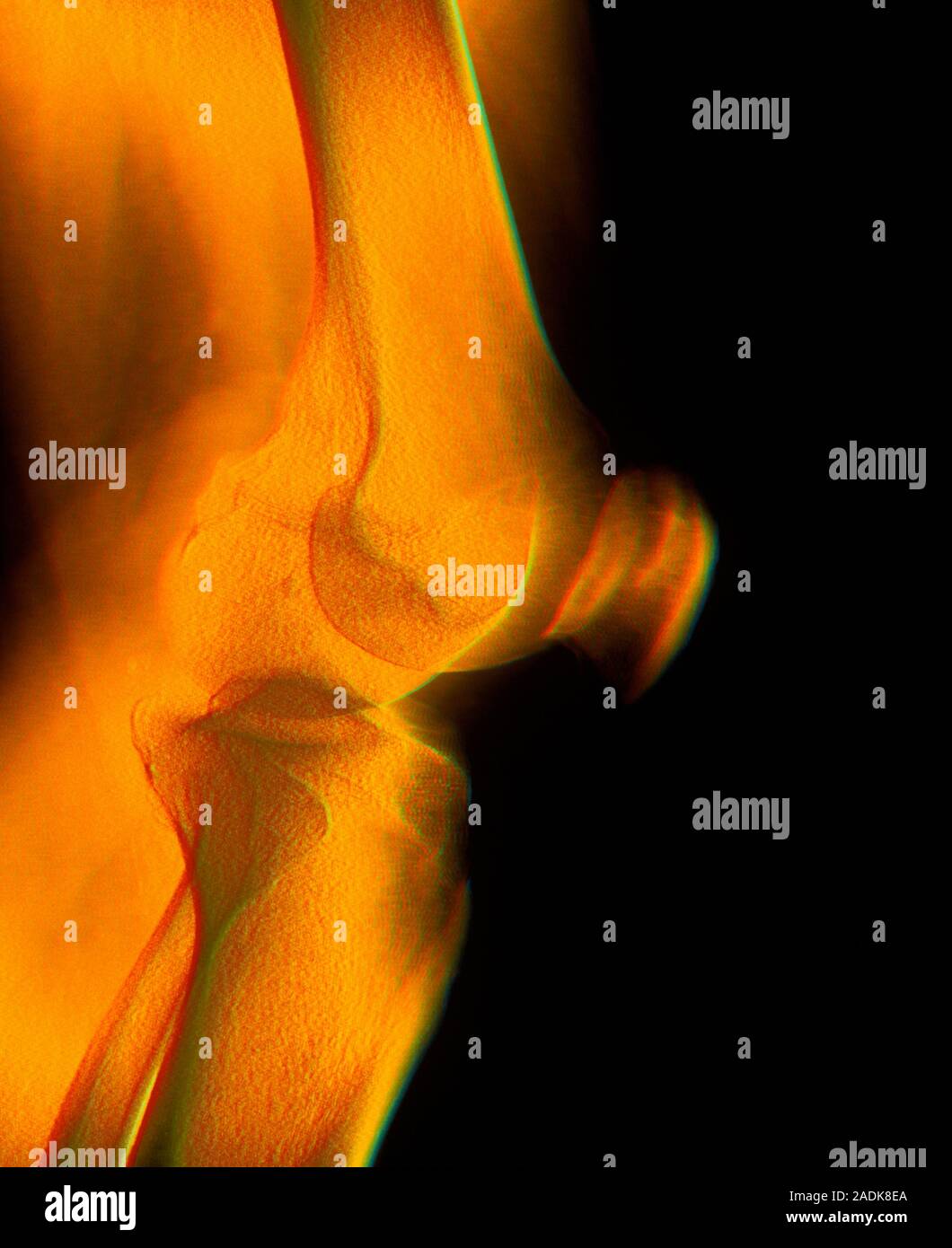Knee joint. Coloured X-ray of a healthy human knee joint seen from the ...