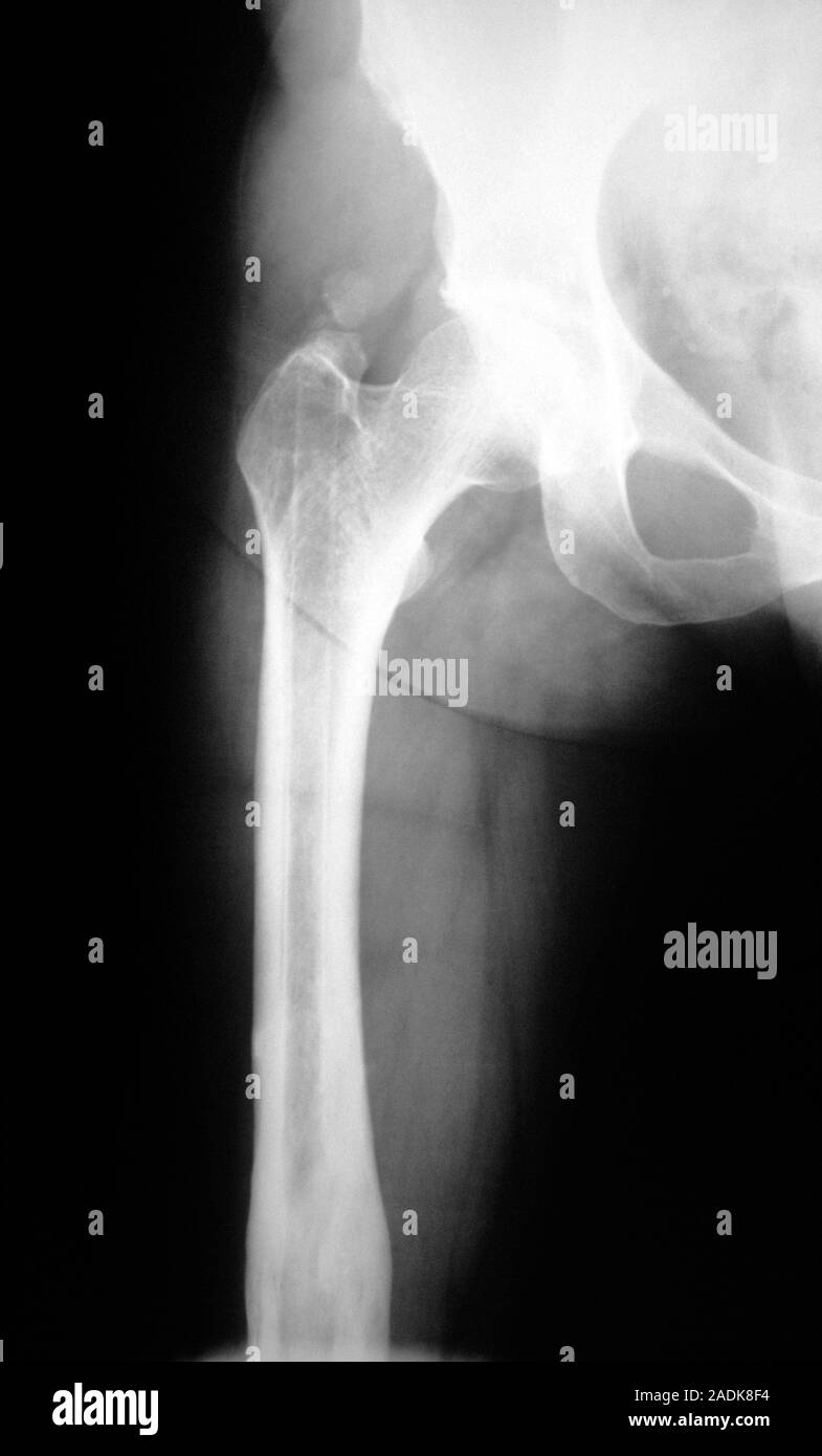 Hip joint. Xray of a normal human hip joint. The hip joint is formed