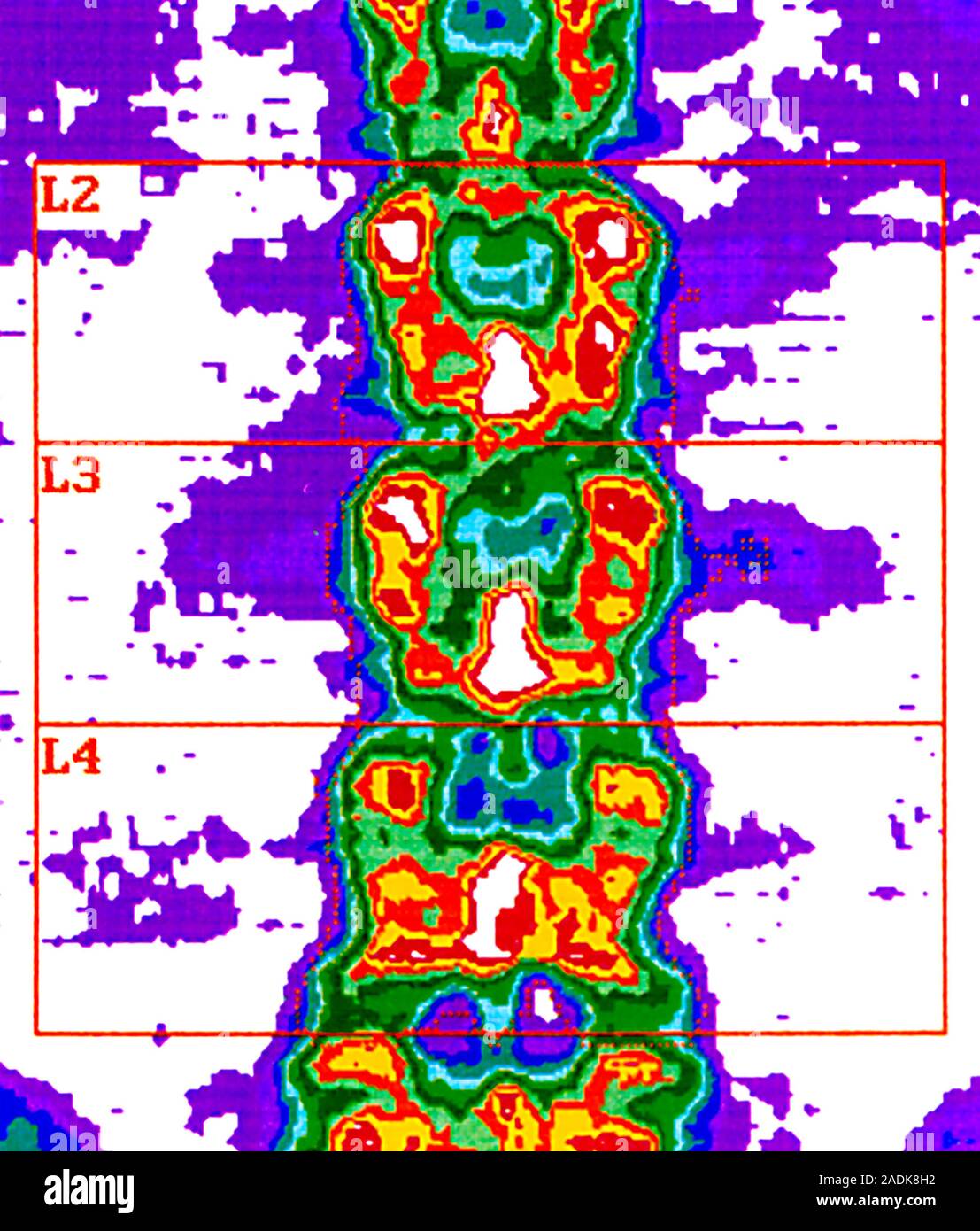 Spinal scan. Coloured bone densitometry scan of the lumbar (lower