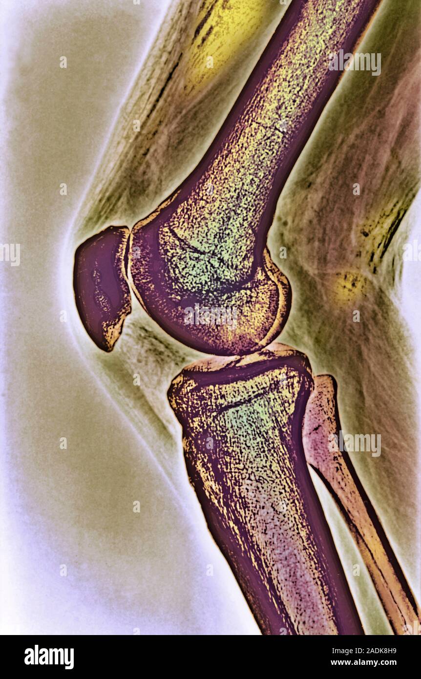 Knee joint. Coloured Xray of a healthy knee joint. The joint is