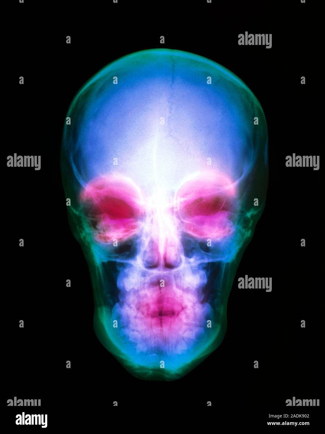 Human skull. Coloured X-ray of a human skull, seen from the front. At ...