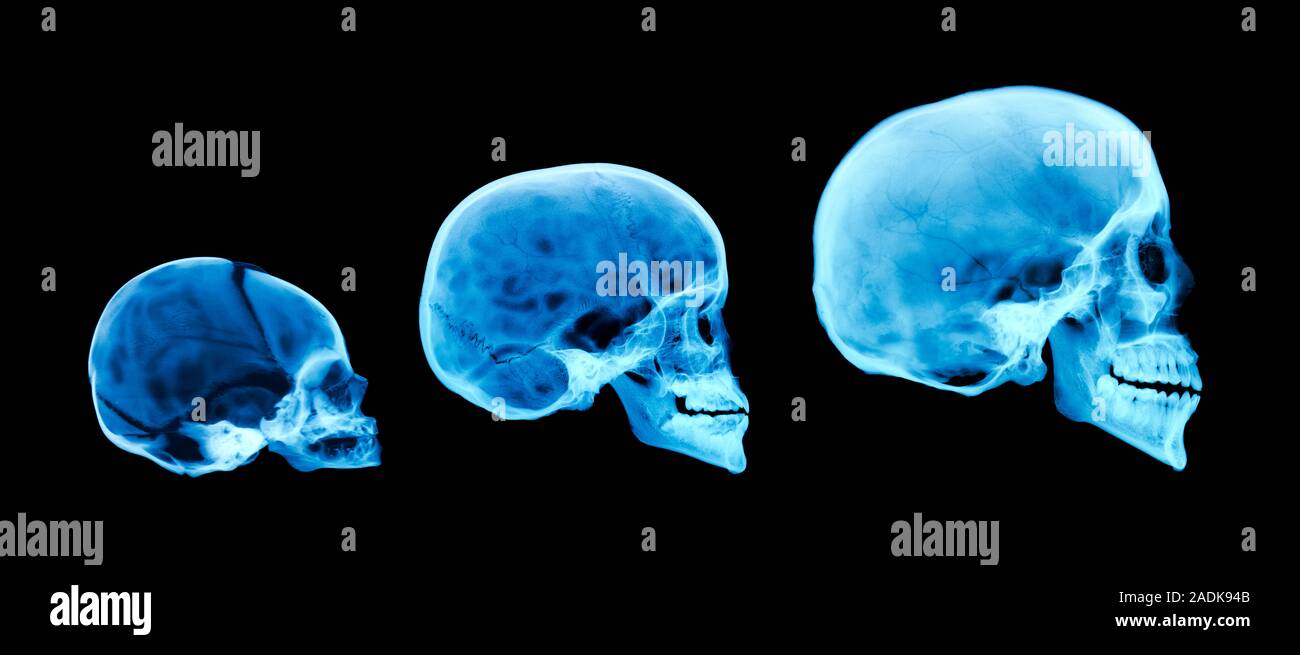 Human skull development. Coloured xray of three human skulls including