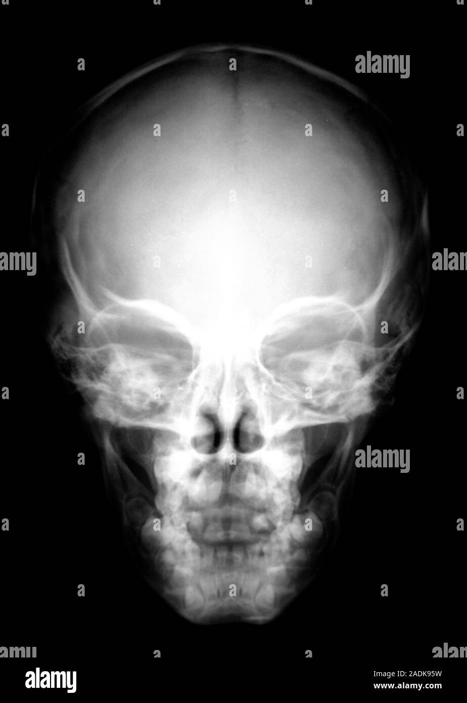 Facial sinuses. Xray of the skull of a young child, showing normal facial sinuses. The sinuses
