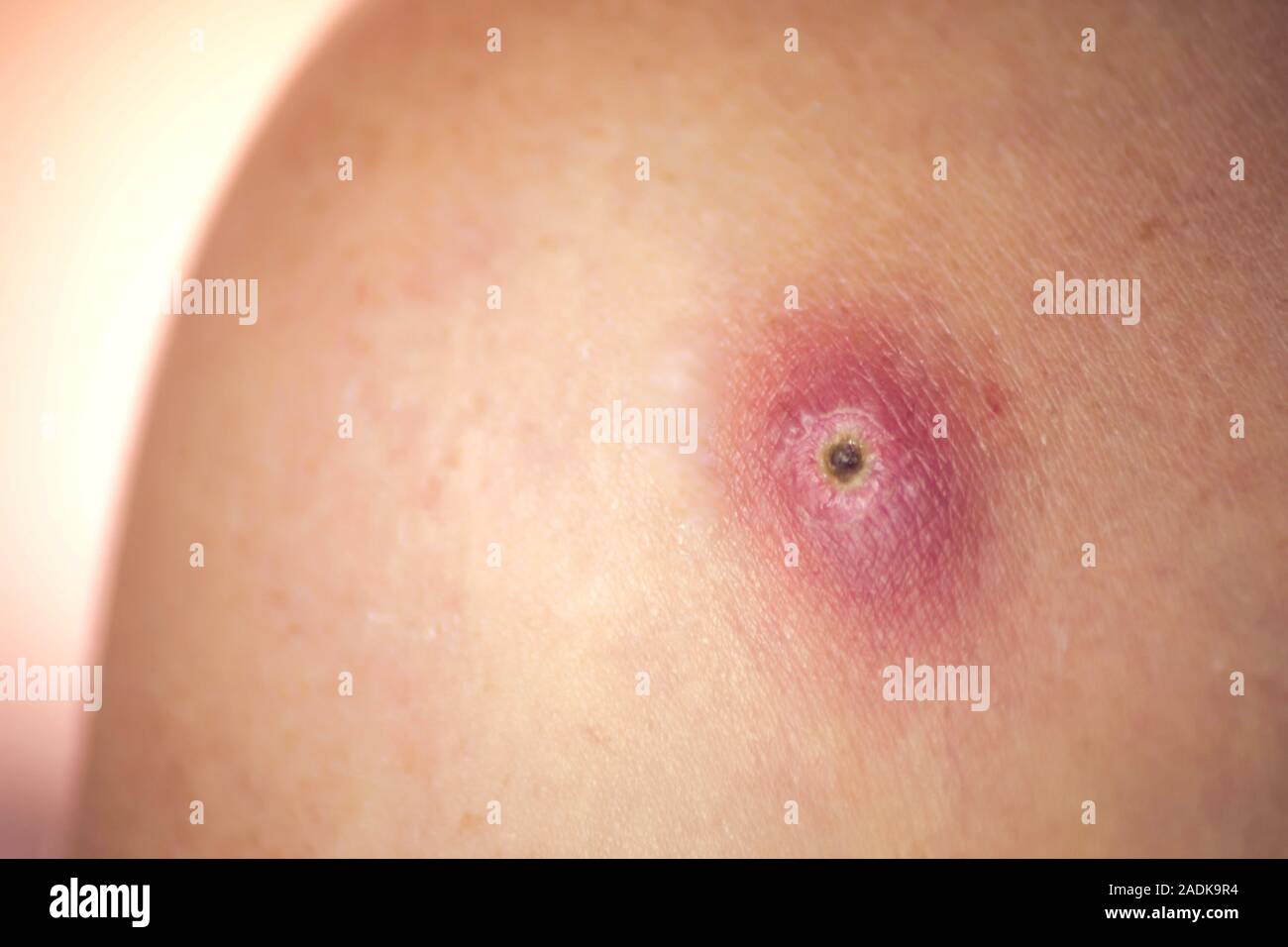 Skin of woman with big and painfull furuncle. People, medicine and skincare  concept Stock Photo - Alamy