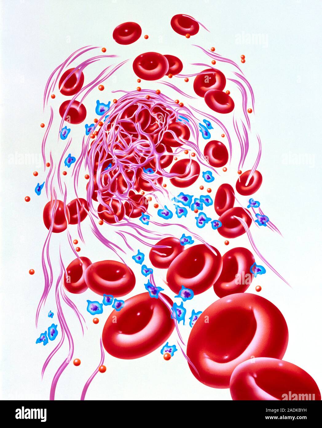 Dissolving blood clot. Illustration of a human blood clot (thrombus) in