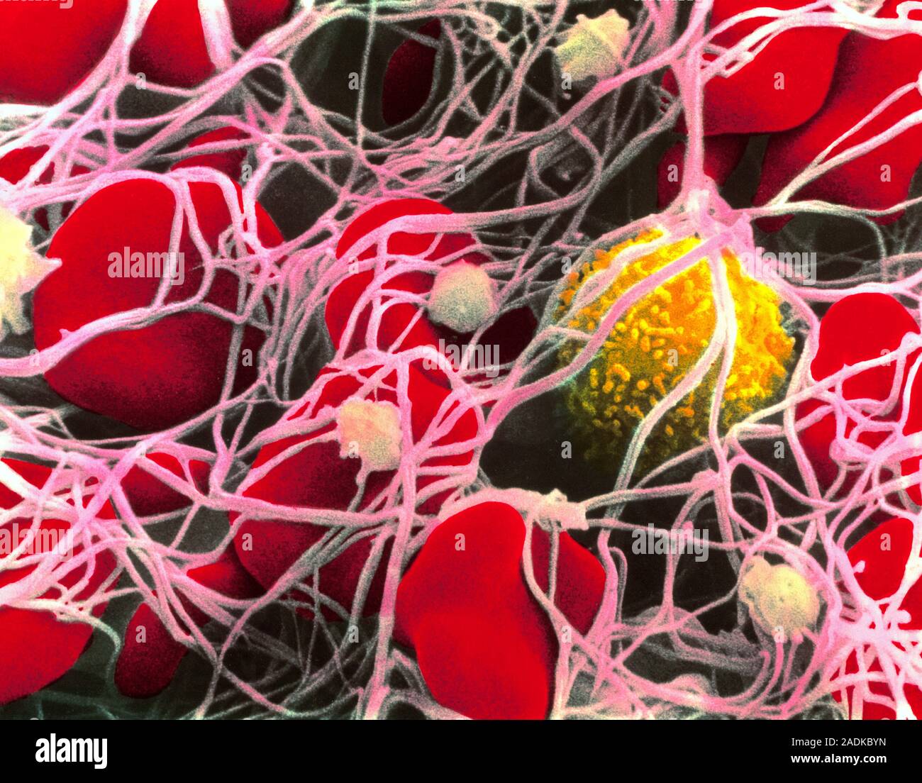 Blood clot. Coloured Scanning Electron Micrograph (SEM) of a blood clot ...