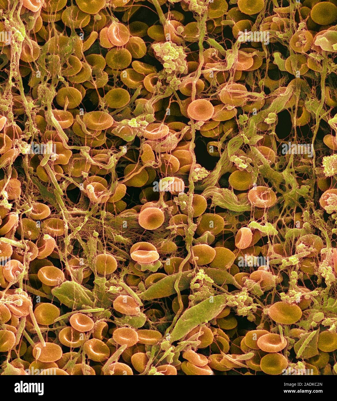 Blood clot. Coloured scanning electron micrograph (SEM) of a blood clot