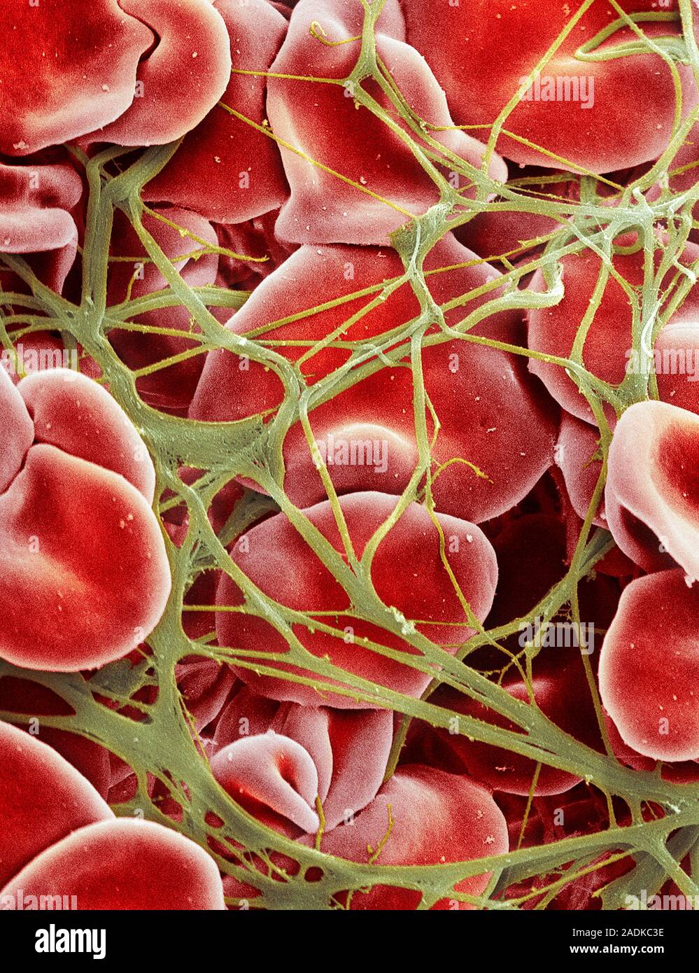 Blood clot. Coloured scanning electron micrograph (SEM) of red blood cells (erythrocytes) trapped in a fibrin mesh (green). The production of fibrin i Stock Photo