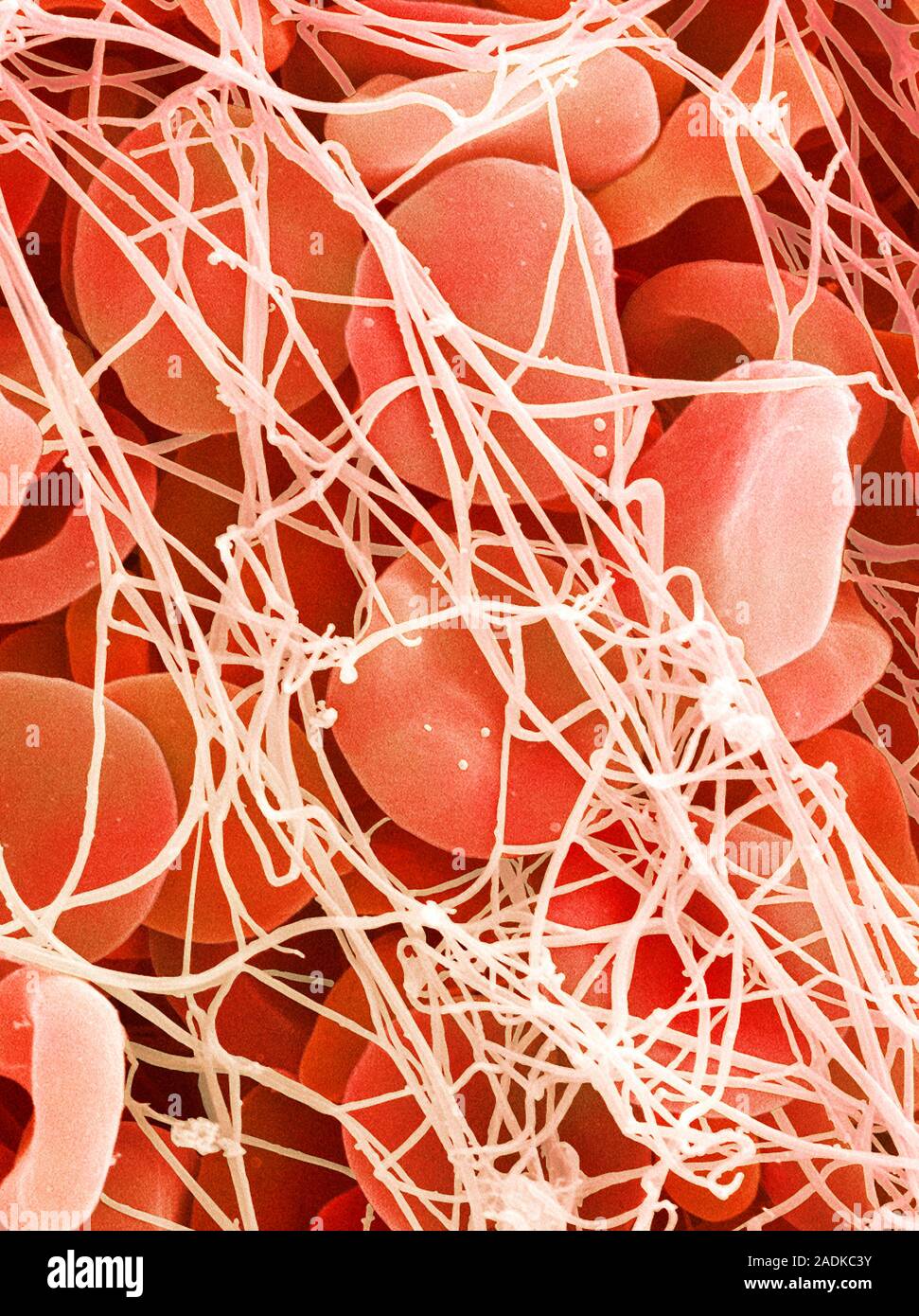 Blood clot. Coloured scanning electron micrograph (SEM) of a blood clot