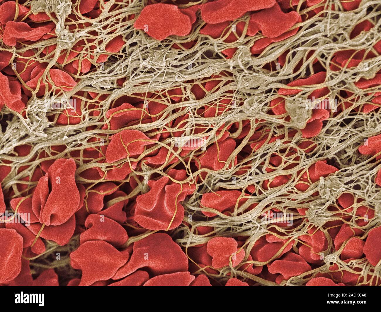 Blood clot. Coloured scanning electron micrograph (SEM) of a blood clot