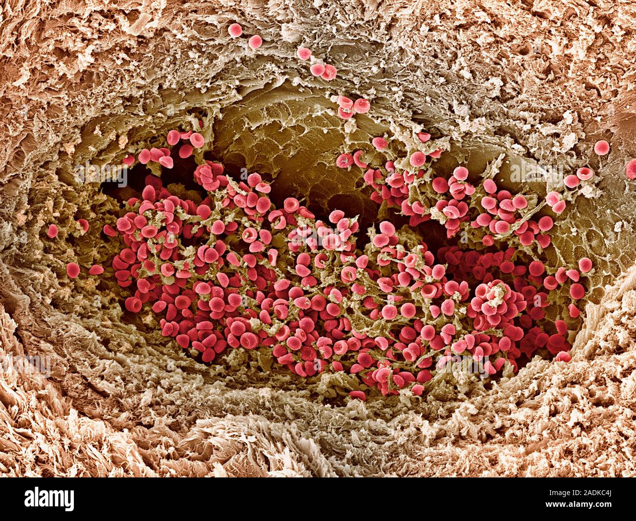 Blood clot. Coloured scanning electron micrograph (SEM) of a freeze ...