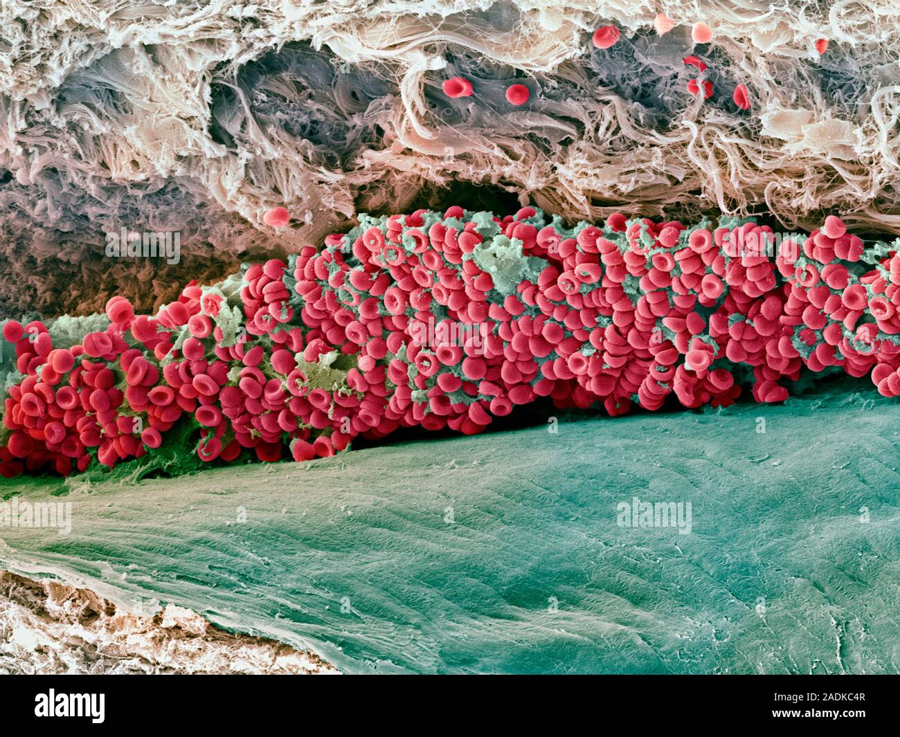 Blood clot. Coloured scanning electron micrograph (SEM) of a freeze
