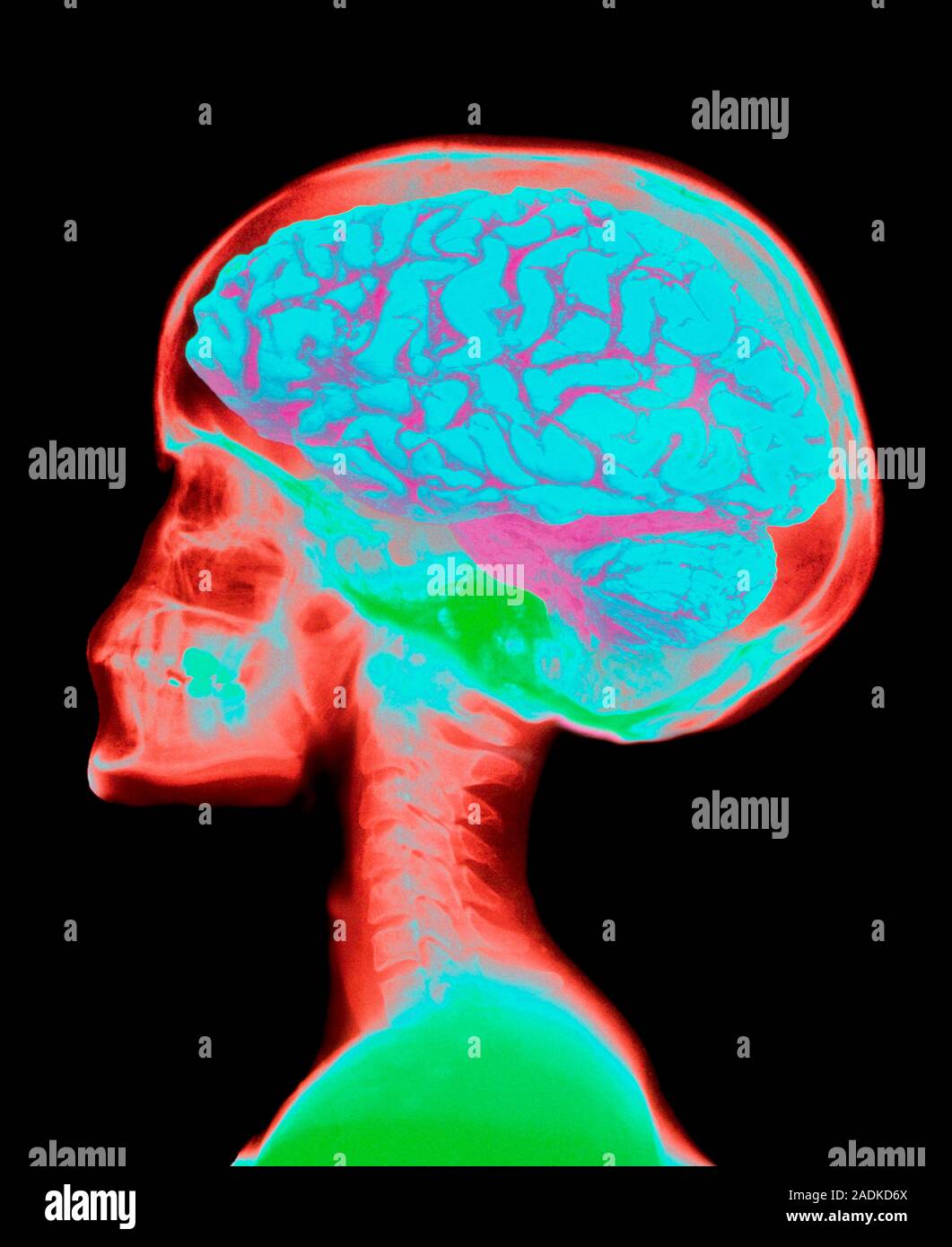 Healthy brain in skull. Coloured computer-enhanced X-ray of the human ...