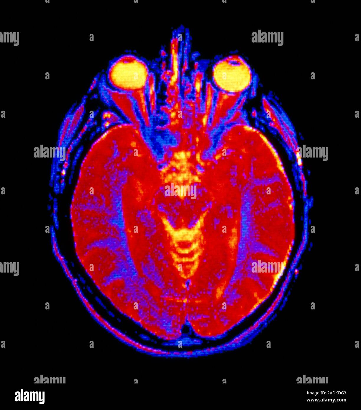 False-colour Magnetic Resonance Image (MRI) of an axial section through ...