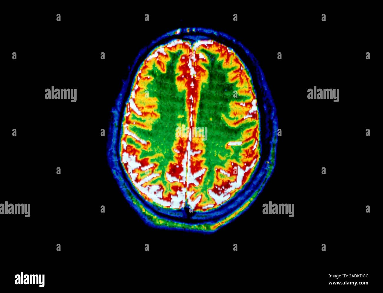 False-colour Magnetic Resonance Image (MRI) of an axial section through ...