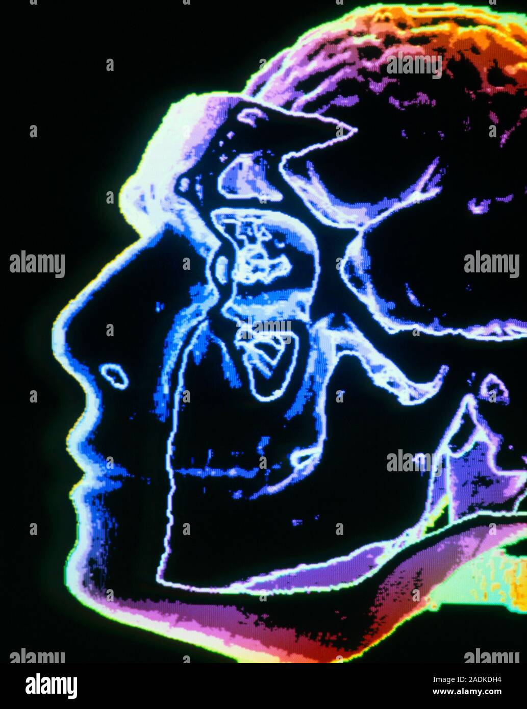 Brain in head. False-colour three-dimensional computed tomography (CT ...