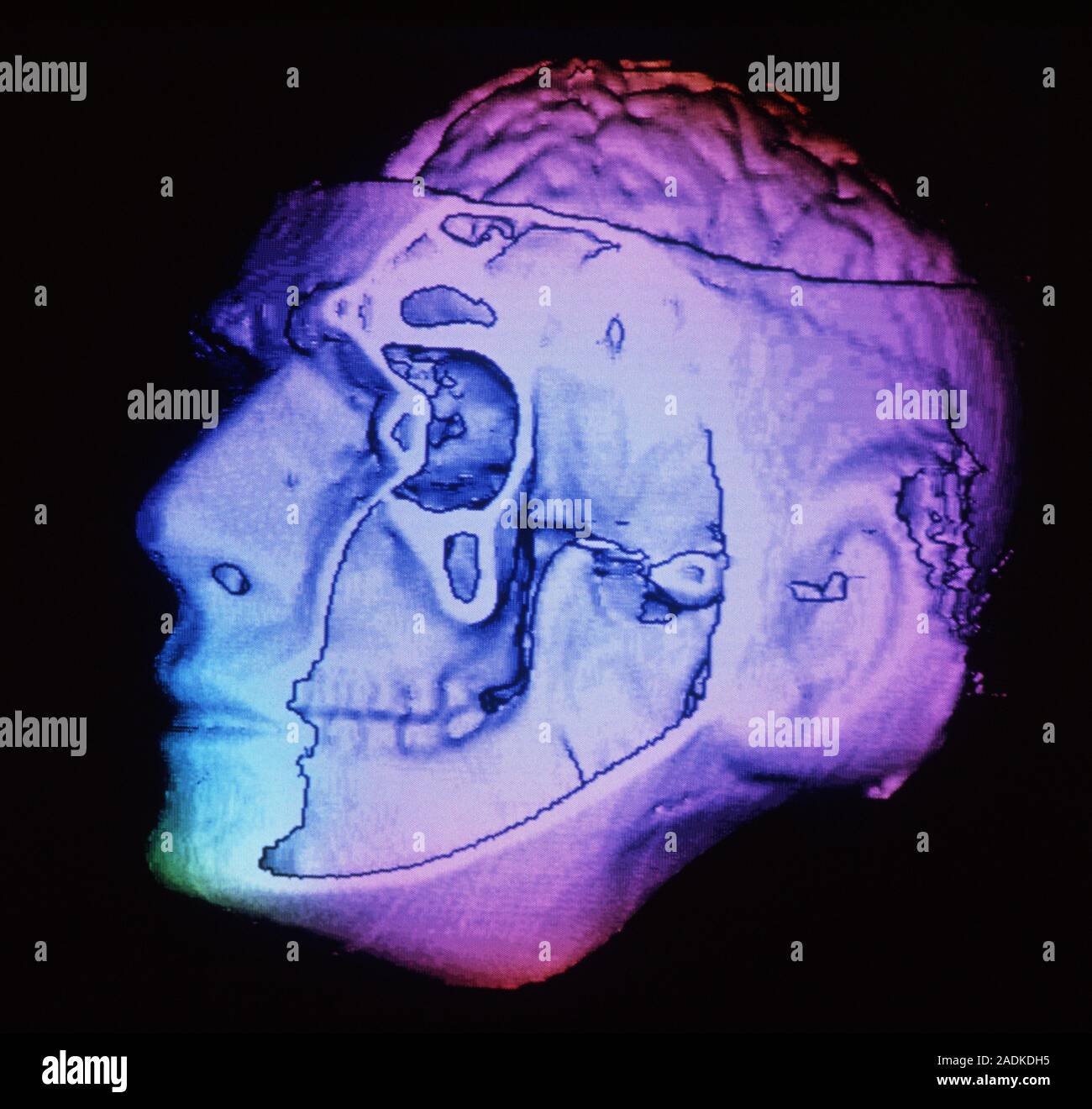 Brain in head. False-colour three-dimensional computed tomography (CT ...