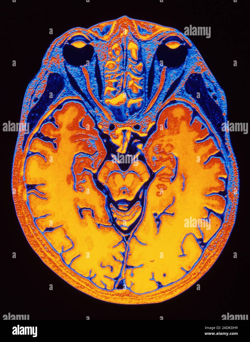 Brain scan. False-colour magnetic resonance imaging (MRI) scan of a ...