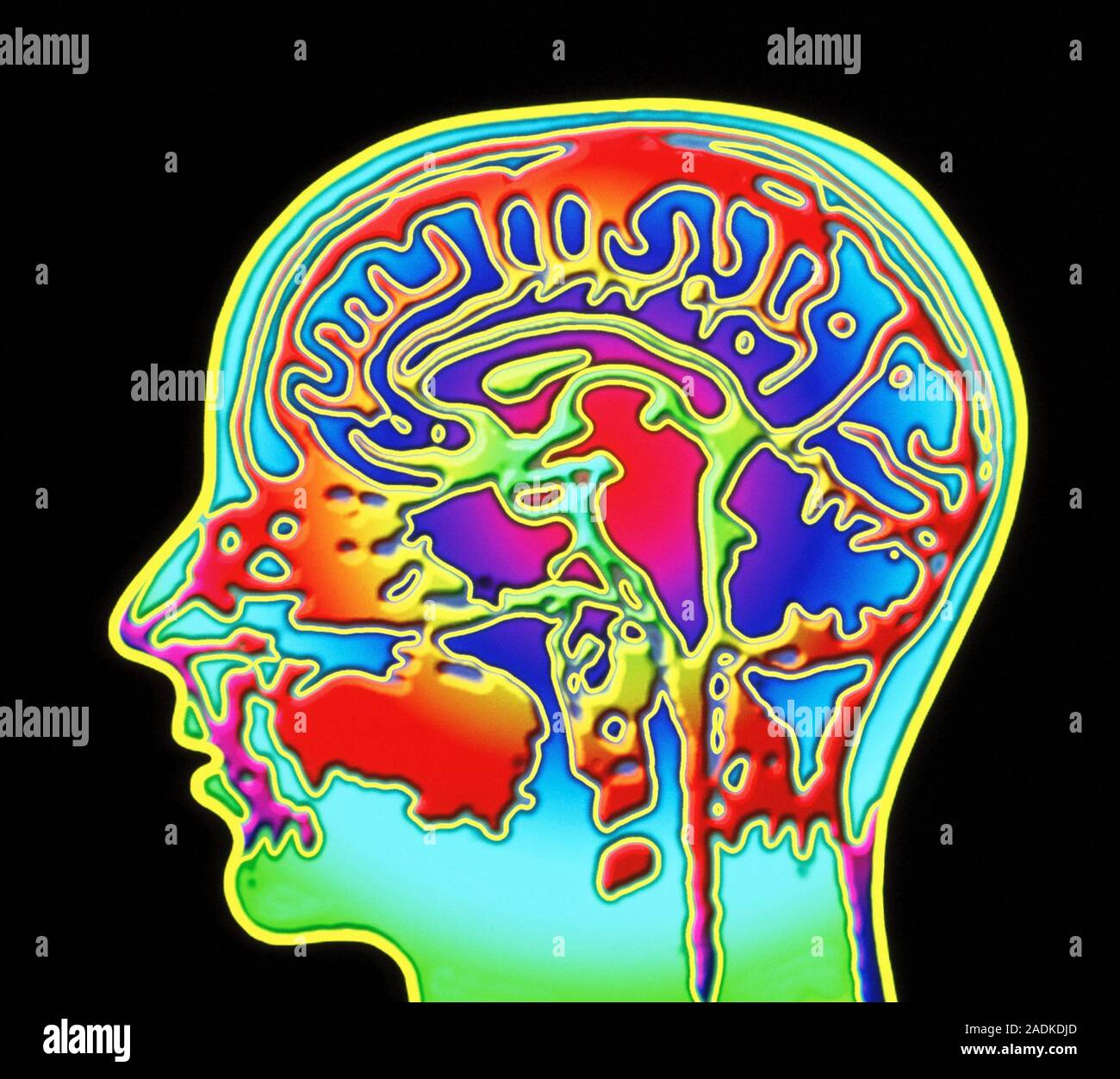 Brain scan. Coloured Magnetic Resonance Imaging (MRI) scan through a ...