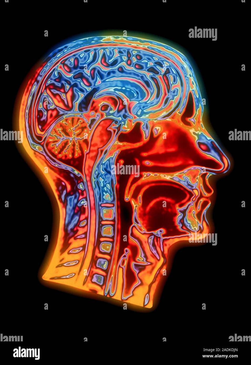 Brain scan. Coloured Magnetic Resonance Imaging (MRI) scan through a ...