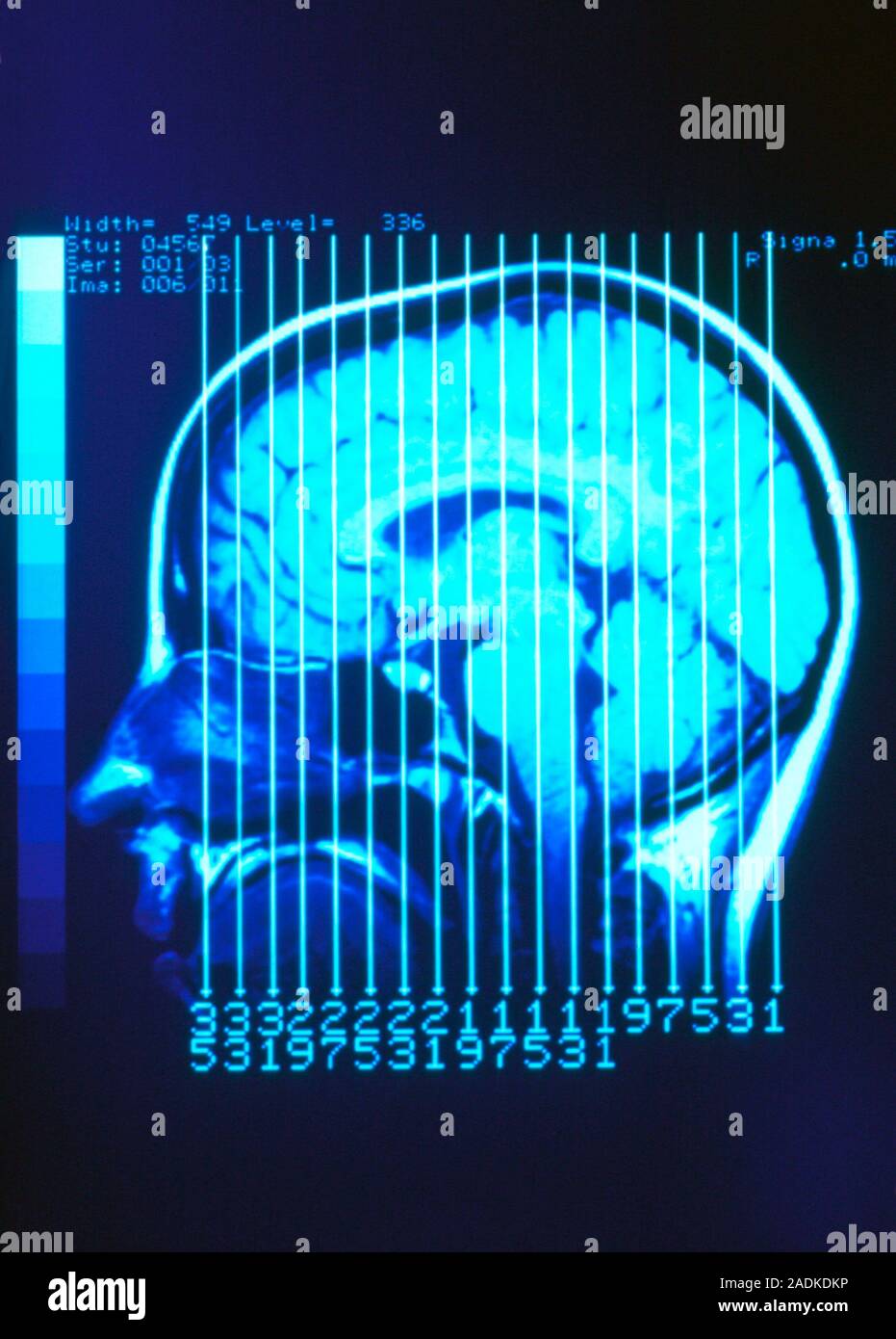 Healthy brain. Coloured magnetic resonance imaging (MRI) scan of a ...